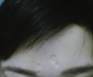 ​脸部皮肤修复 面部旧疤该如何修复？需要多长时间能修复好？