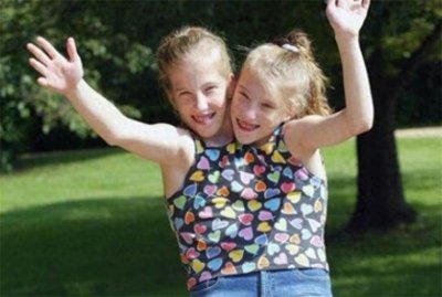 ​美国“双头”连体姐妹花：两个头各控制一半身体，配合相当默契