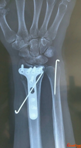 ​桡骨是身体的哪个部位?桡骨是什么部位?