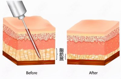 ​吸脂减肥 吸脂是否可以用来减肥，应该注意哪些方面？
